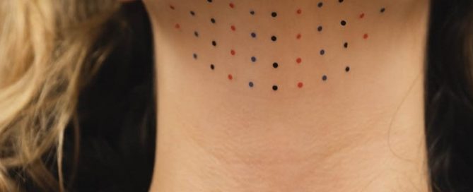 Laying out injection dots for Kybella therapy