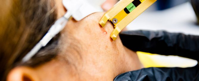 Acne laser procedure