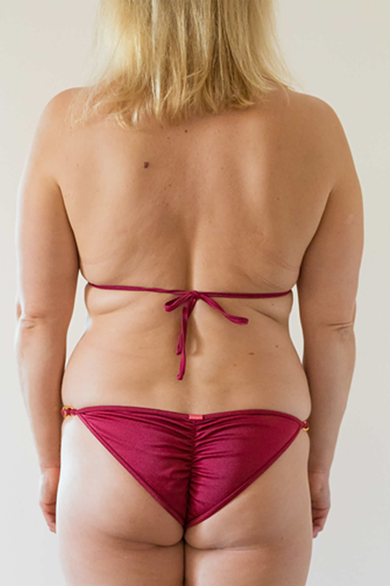 Jenny Back Before Weight Loss Treatment