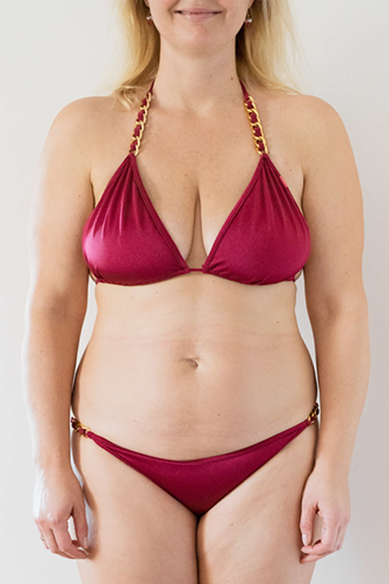 Jenny Front Before Weight Loss Treatment