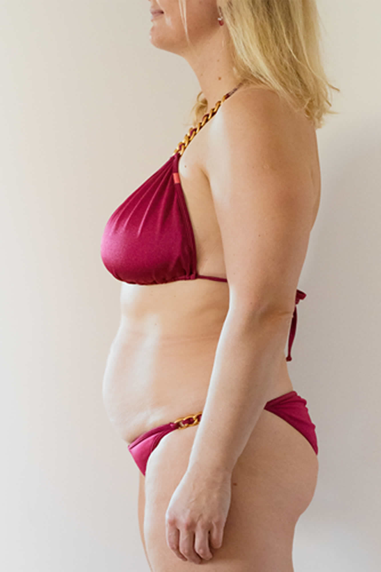 Jenny Side Before Weight Loss Treatment
